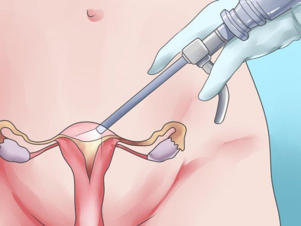Выскабливание полости матки (гинекология) — отзывы