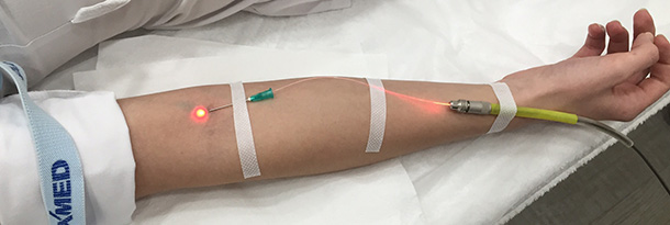 Внутрисосудистое лазерное облучение крови (Влок) — отзывы