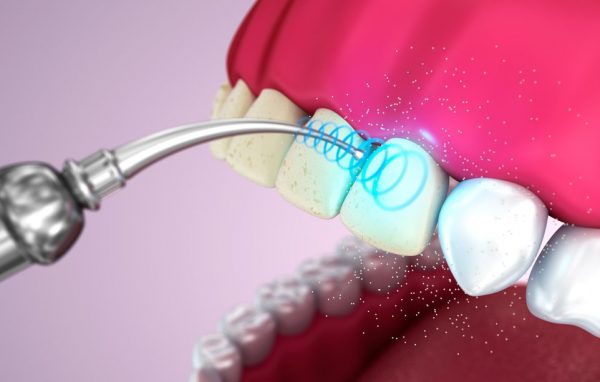 Ультразвуковая чистка зубов — отзывы