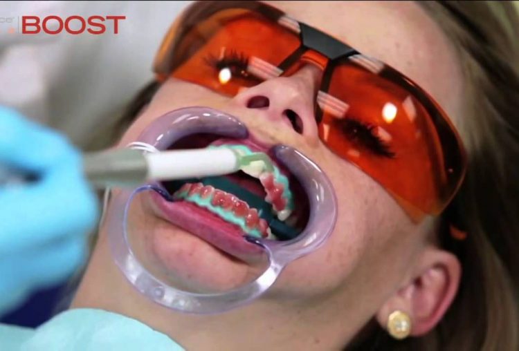 Отбеливание зубов OpalescenceBoost — отзывы