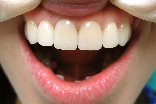 Зубные коронки из металлокерамики — отзывы