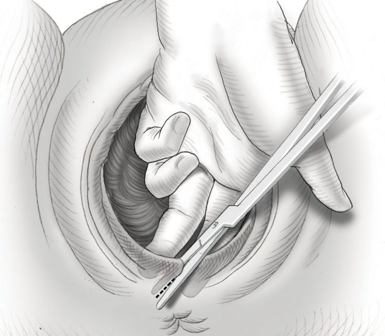 Сколько рассасываются швы после вагинопластики?